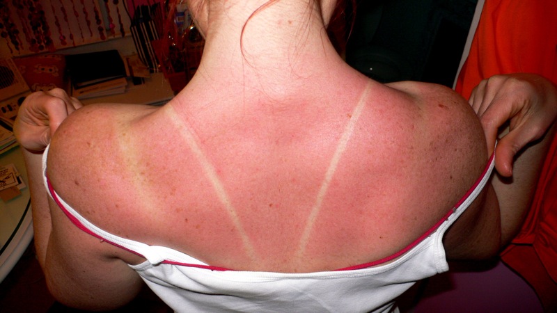 Sunburn Cures For Your Sunburned Ass