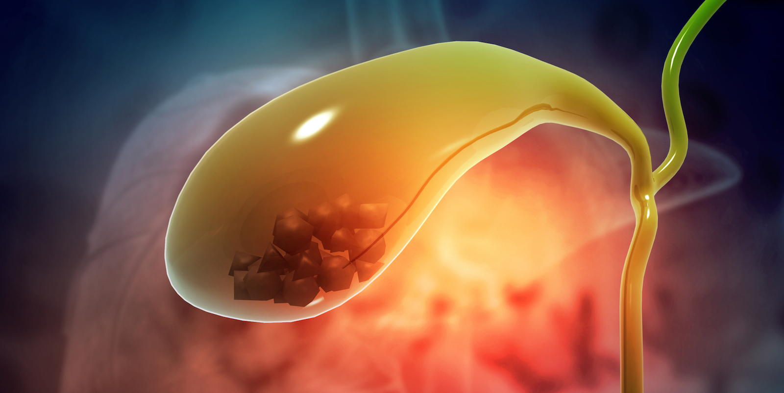 Gallbladder with gallstones